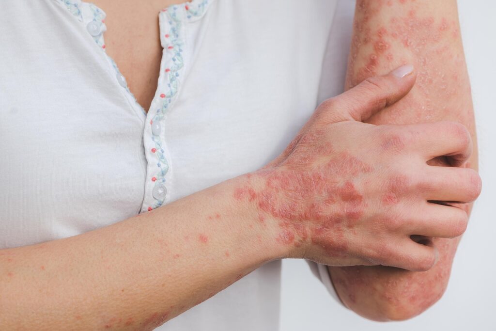 psoriasis, skin, disease, inflammation, scaly, skin disease, red, inflamed, patient, psoriasis, psoriasis, psoriasis, psoriasis, psoriasis, inflammation, skin disease, skin disease